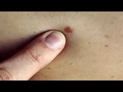 تعرف على ما هي أعراض السرطان المبكرة