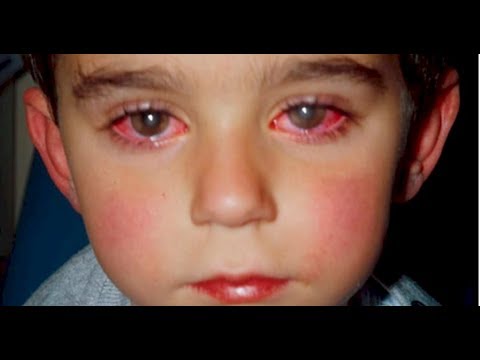 ولد فقد 75 بالمئة من نظره بسبب هذا الشيء الذي نجده في کل البيوت