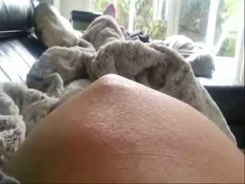 جنين يكاد يخترق بطن أمه